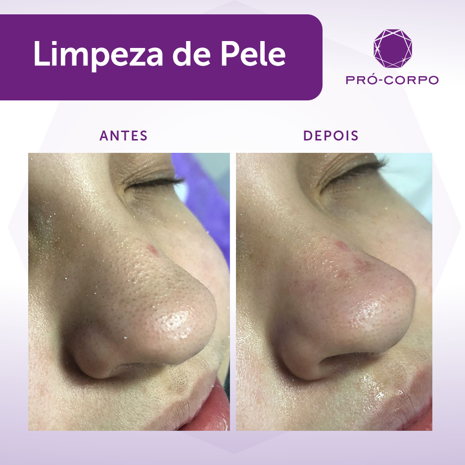 limpeza de pele profissional para cravos